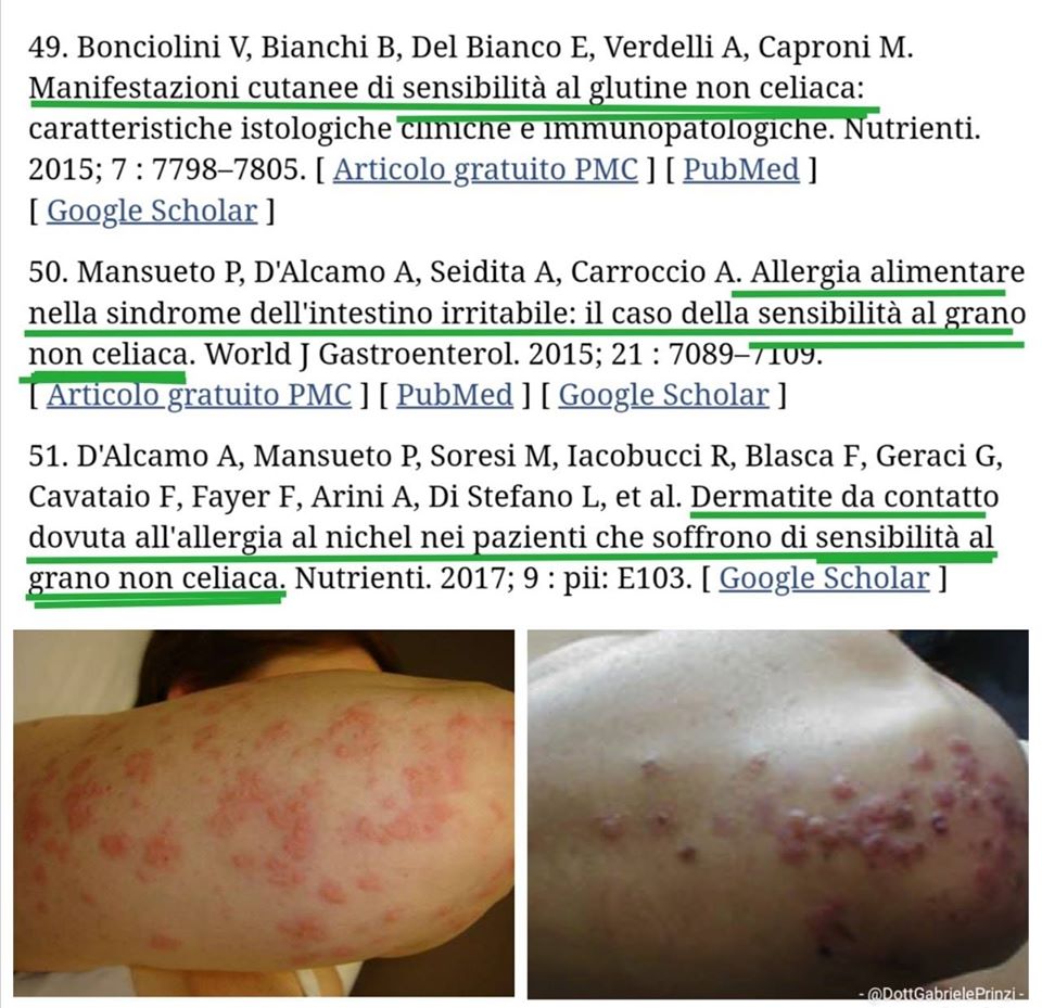 Dermatite Erpetiforme come manifestazioni extraintestinale da Sensibilità al Glutine.
